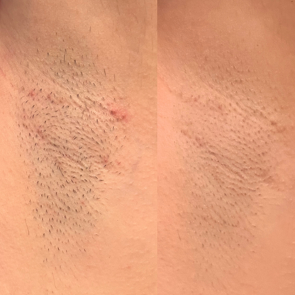 Side-by-side comparison: On the left, underarm area with visible ingrown hairs; on the right, the same area after using the ingrown hair treatment. Noticeable reduction in ingrown hairs and smoother skin texture."