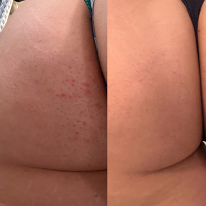 Comparison image: On the left, skin with body acne; on the right, the same skin after using the skin relief bundle. Noticeable improvement in complexion and reduction in acne.