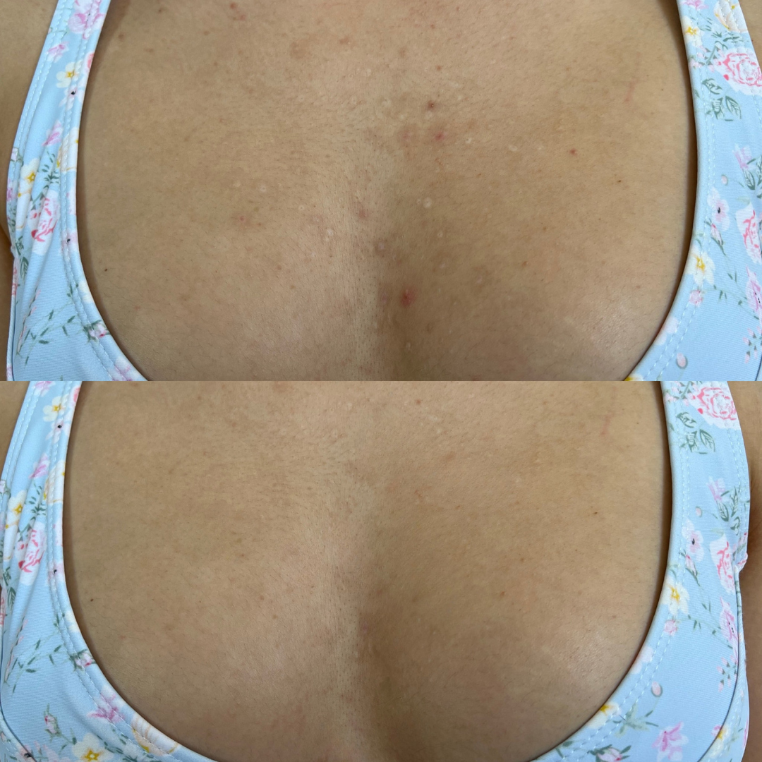 Result image: A chest area with visible acne before using the skincare treatment, and the same area post- Bumbee Beauty skin relief bundle showing significant improvement with reduced acne and clearer skin